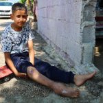 Adana'da Yeniden Yürümeye Başlayan Küçük Serdal'ın İlham Verici İyileşme Hikayesi