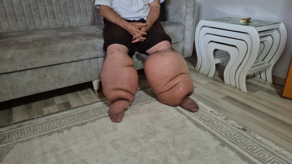 15 Yıllık Mücadele: Fil Hastalığıyla Savaşan Bir Adamın Hikayesi